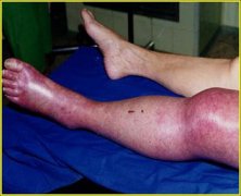 下肢深静脉血栓患者的典型案例